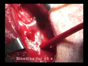Hemo-Bandage: arterial hemostasis
